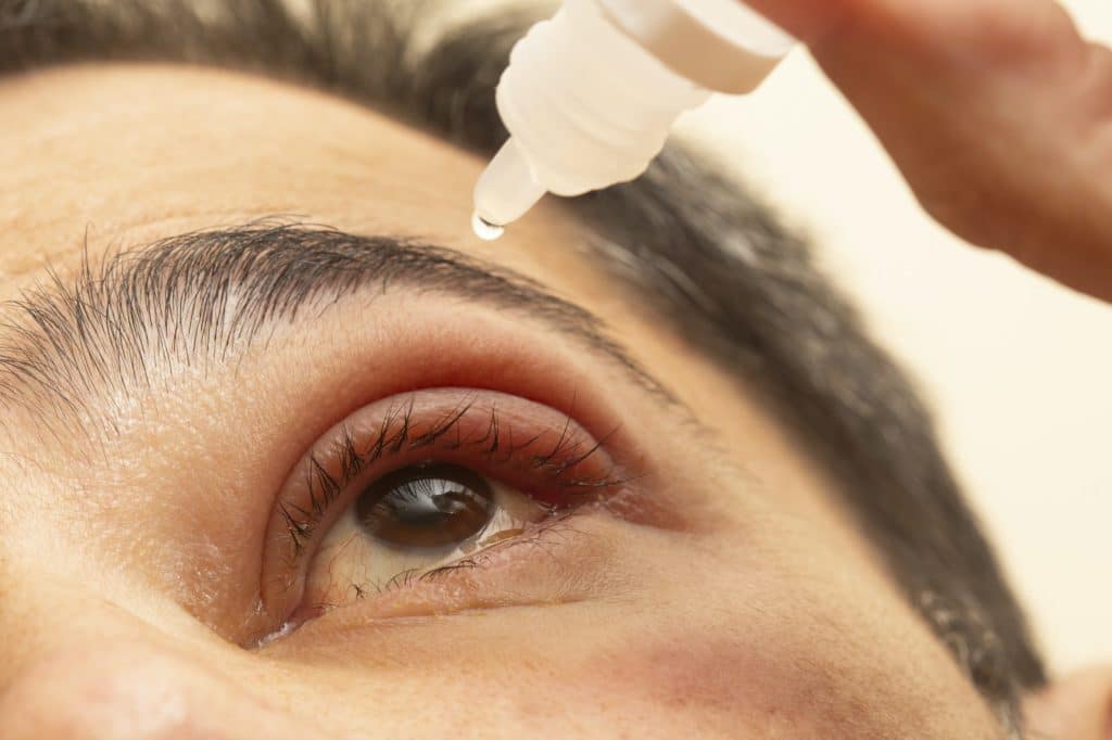 Hand placing drops of eye drops in inflamed eye with infected stye